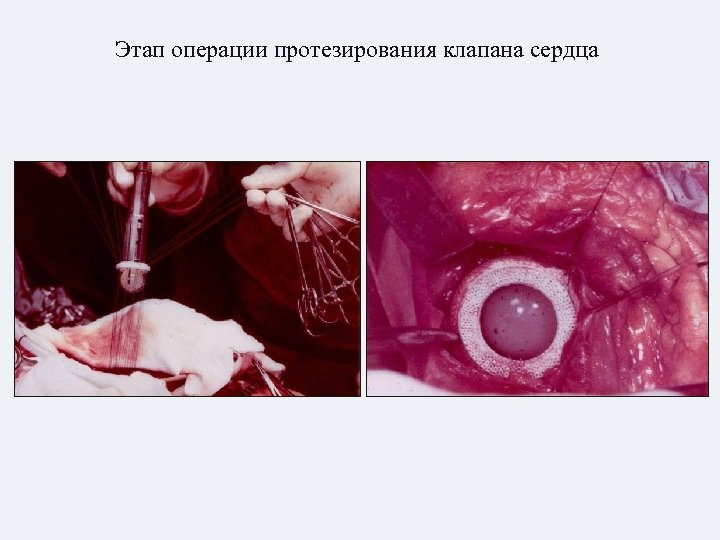 Этап операции протезирования клапана сердца 