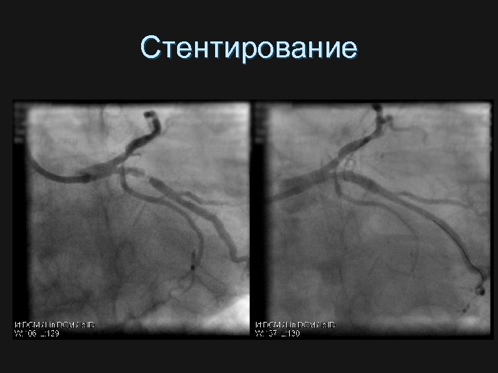 Стентирование 