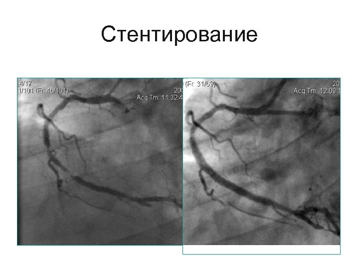 Стентирование 