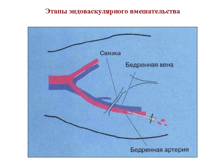 Этапы эндоваскулярного вмешательства 
