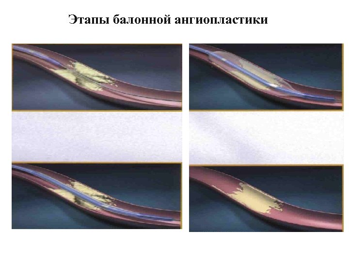 Этапы балонной ангиопластики 
