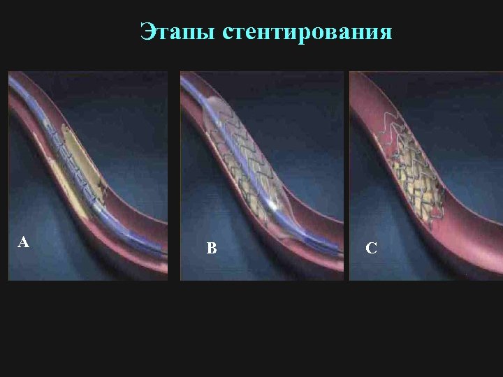 Этапы стентирования А В С 