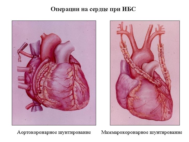 Операции на сердце при ИБС Аортокоронарное шунтирование Маммарокоронарное шунтирование 