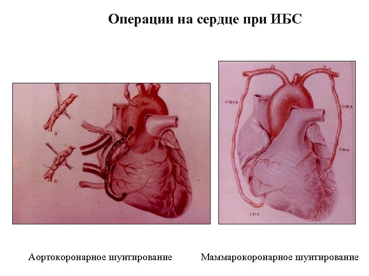 Операции на сердце при ИБС Аортокоронарное шунтирование Маммарокоронарное шунтирование 