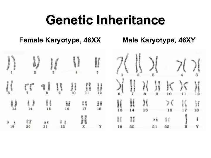 Genetic Inheritance Female Karyotype, 46 XX Male Karyotype, 46 XY 