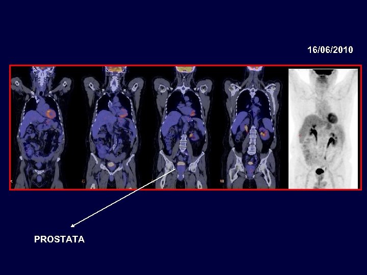 16/06/2010 PROSTATA 