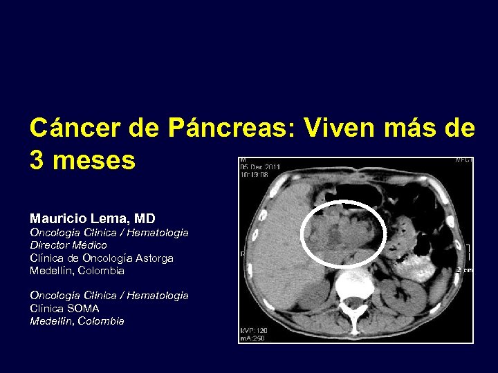 Cáncer de Páncreas: Viven más de 3 meses Mauricio Lema, MD Oncología Clínica /