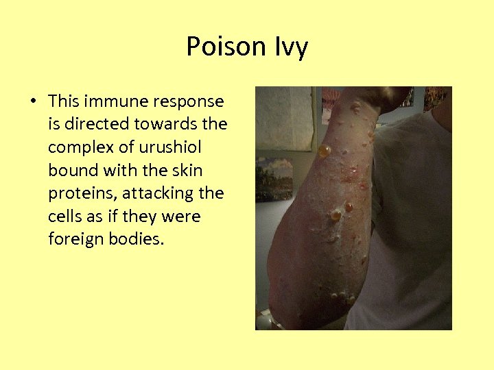 Poison Ivy • This immune response is directed towards the complex of urushiol bound