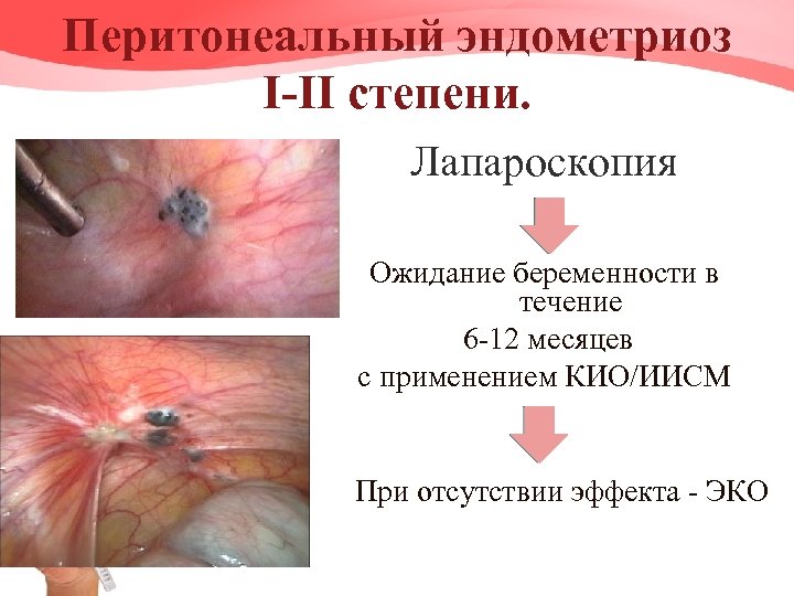 Перитонеальный эндометриоз I-II степени. Лапароскопия Ожидание беременности в течение 6 -12 месяцев с применением