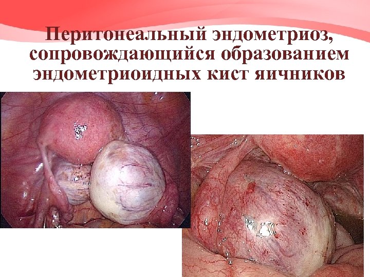 Перитонеальный эндометриоз, сопровождающийся образованием эндометриоидных кист яичников 