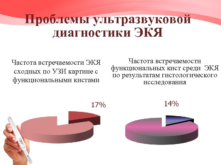 Проблемы ультразвуковой диагностики ЭКЯ Частота встречаемости ЭКЯ сходных по УЗИ картине с функциональными кистами