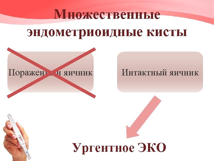 Множественные эндометриоидные кисты Пораженный яичник Интактный яичник Ургентное ЭКО 