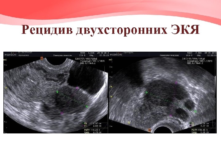 Рецидив двухсторонних ЭКЯ 