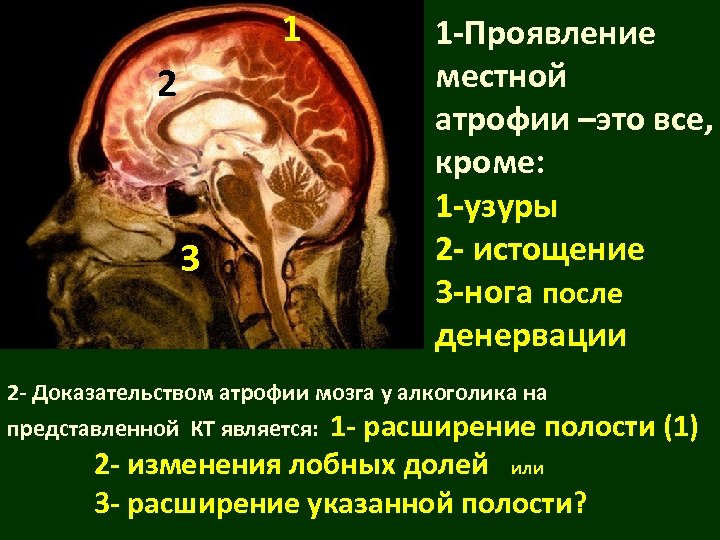 Полость расширена. Морфогенез мозга. Проявление местной атрофии. Проявлениями местной атрофии являются. Проявление местной атрофии явл.