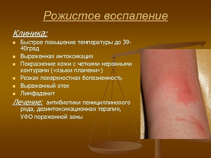 Рожистое воспаление Клиника: n n n Быстрое повышение температуры до 3940 град Выраженная интоксикация