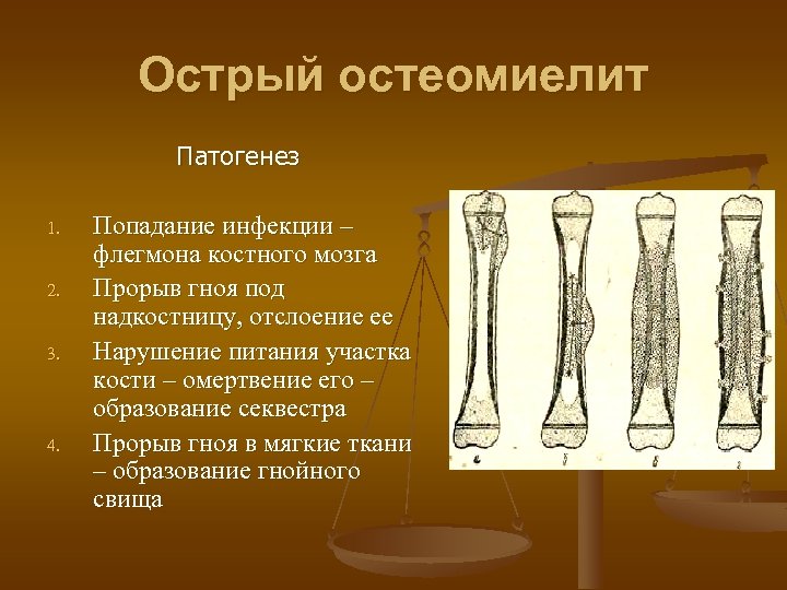 Острый остеомиелит Патогенез 1. 2. 3. 4. Попадание инфекции – флегмона костного мозга Прорыв