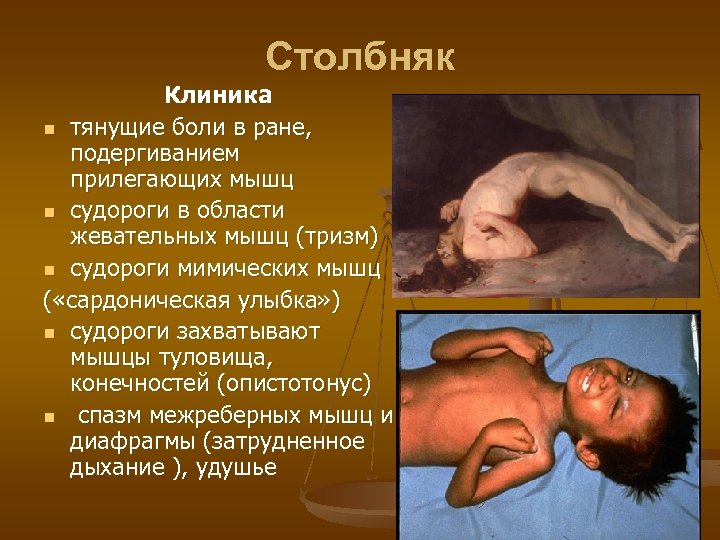 Столбняк Клиника n тянущие боли в ране, подергиванием прилегающих мышц n судороги в области