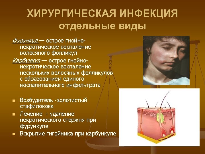 ХИРУРГИЧЕСКАЯ ИНФЕКЦИЯ отдельные виды Фурункул — острое гнойно- некротическое воспаление волосяного фолликул Карбункул —