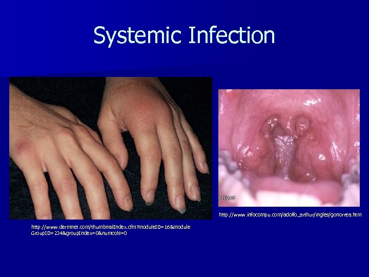 Systemic Infection http: //www. infocompu. com/adolfo_arthur/ingles/gonorrea. htm http: //www. dermnet. com/thumbnail. Index. cfm? module.