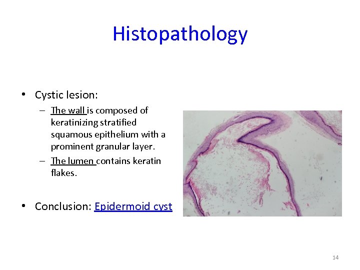 Histopathology • Cystic lesion: – The wall is composed of keratinizing stratified squamous epithelium