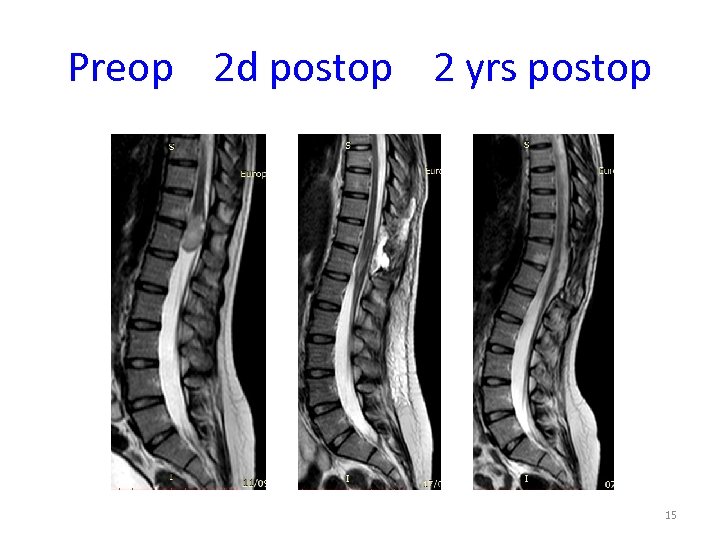 Preop 2 d postop 2 yrs postop 15 