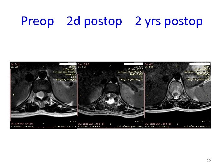 Preop 2 d postop 2 yrs postop 16 