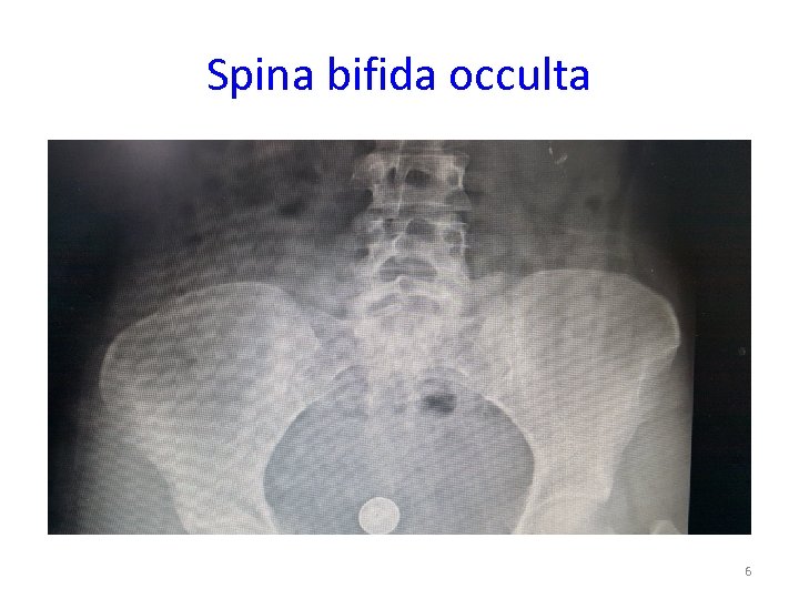 Spina bifida occulta 6 