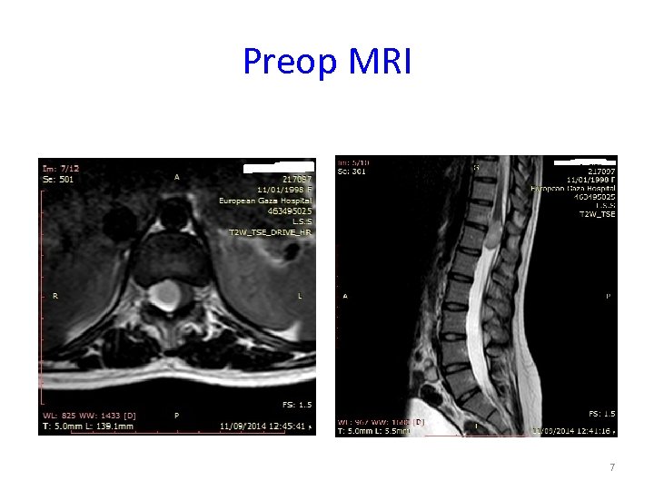 Preop MRI 7 