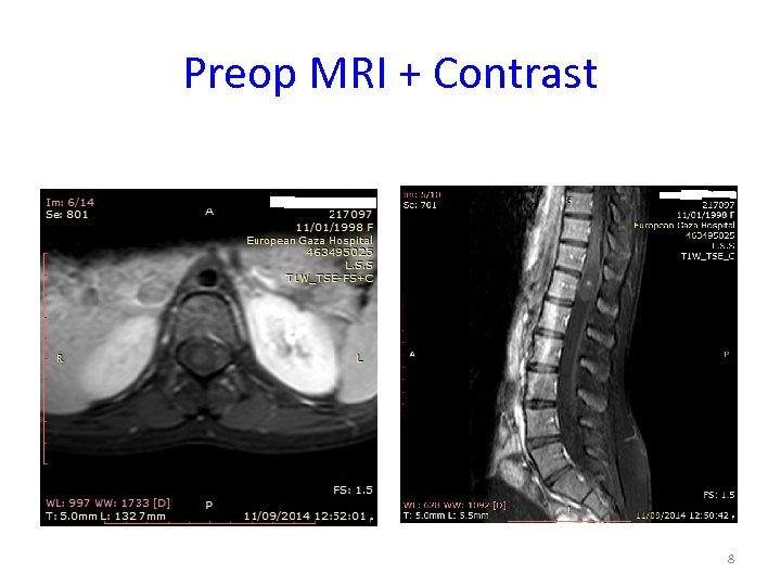 Preop MRI + Contrast 8 