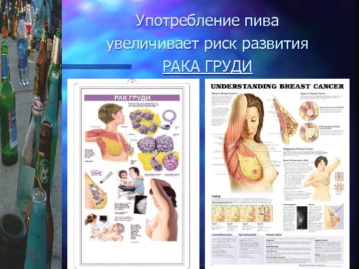 Употребление пива увеличивает риск развития РАКА ГРУДИ 