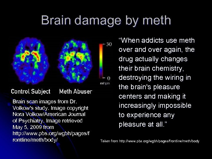 Brain damage by meth Brain scan images from Dr. Volkow's study. Image copyright Nora