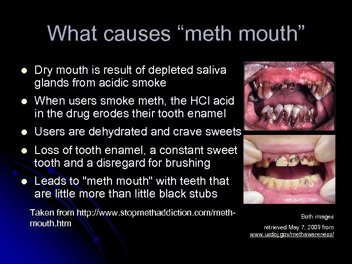 What causes “meth mouth” l Dry mouth is result of depleted saliva glands from