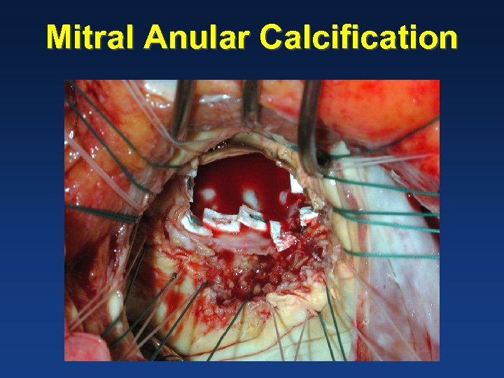 Mitral Anular Calcification 