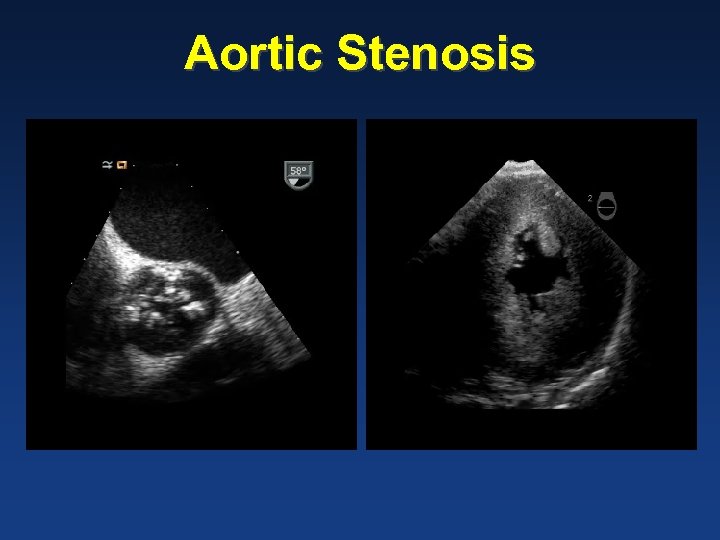 Aortic Stenosis Echo videos 