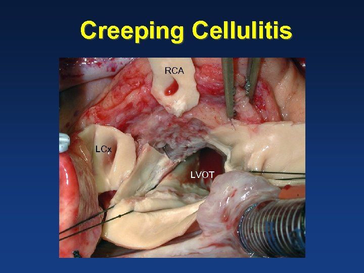 Creeping Cellulitis RCA LCx LVOT 