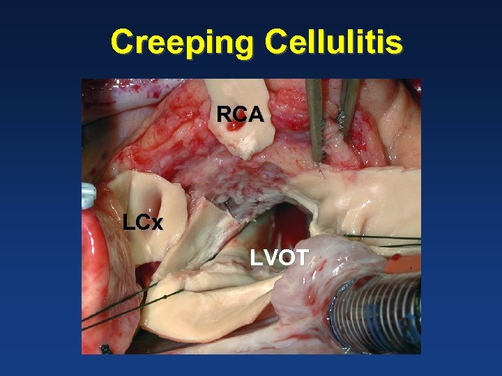 Creeping Cellulitis RCA LCx LVOT 