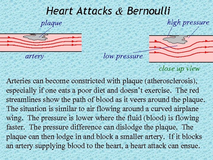 Heart Attacks & Bernoulli high pressure plaque artery low pressure close up view Arteries