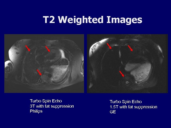 T 2 Weighted Images Turbo Spin Echo 3 T with fat suppression Philips Turbo