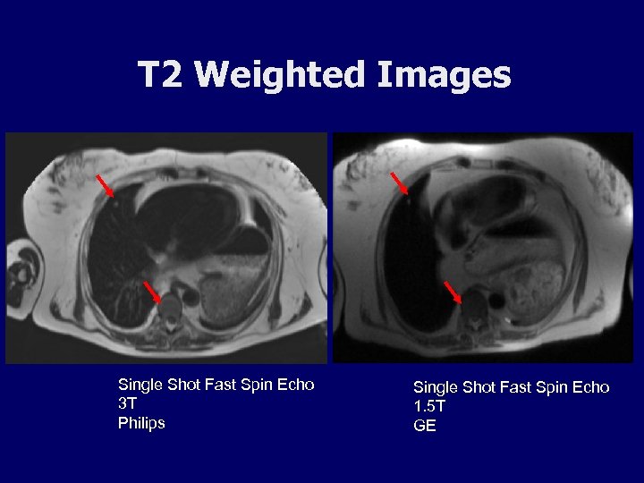 T 2 Weighted Images Single Shot Fast Spin Echo 3 T Philips Single Shot