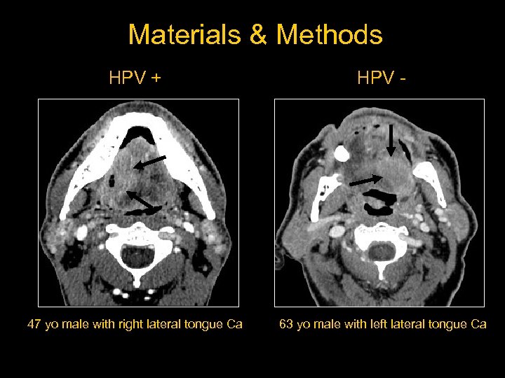 Materials & Methods HPV + HPV - 47 yo male with right lateral tongue