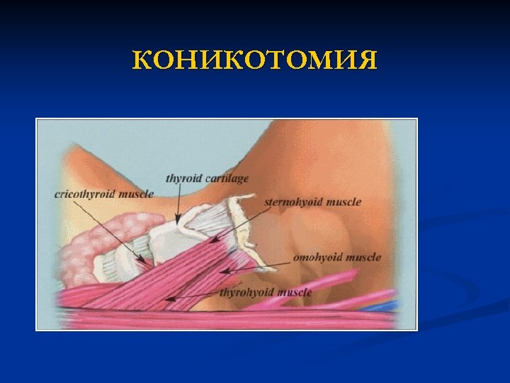 КОНИКОТОМИЯ 