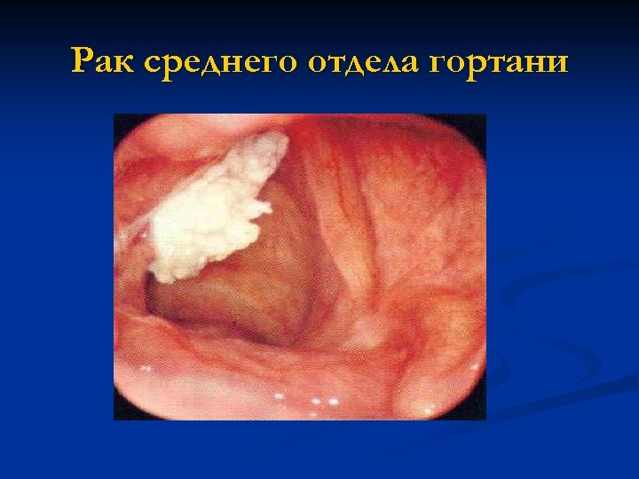 Рак среднего отдела гортани 