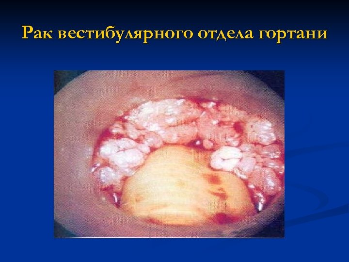 Рак вестибулярного отдела гортани 