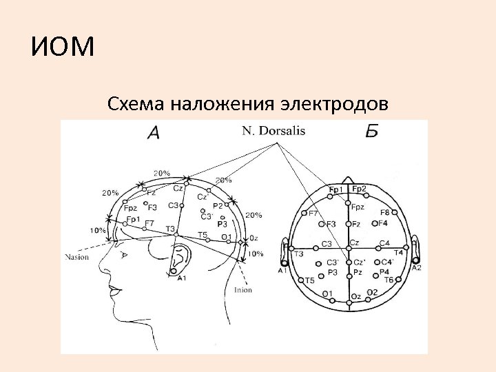 ИОМ Схема наложения электродов 