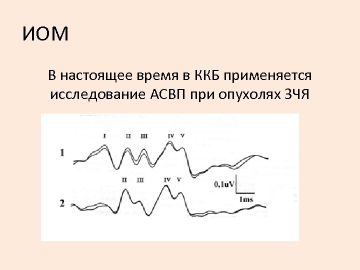 ИОМ В настоящее время в ККБ применяется исследование АСВП при опухолях ЗЧЯ 