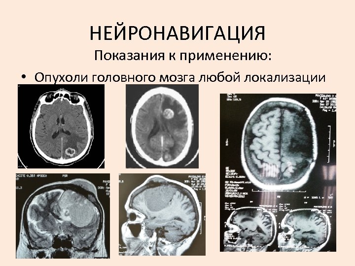 НЕЙРОНАВИГАЦИЯ Показания к применению: • Опухоли головного мозга любой локализации 