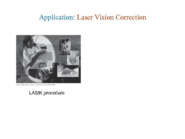 Application: Laser Vision Correction LASIK procedure 
