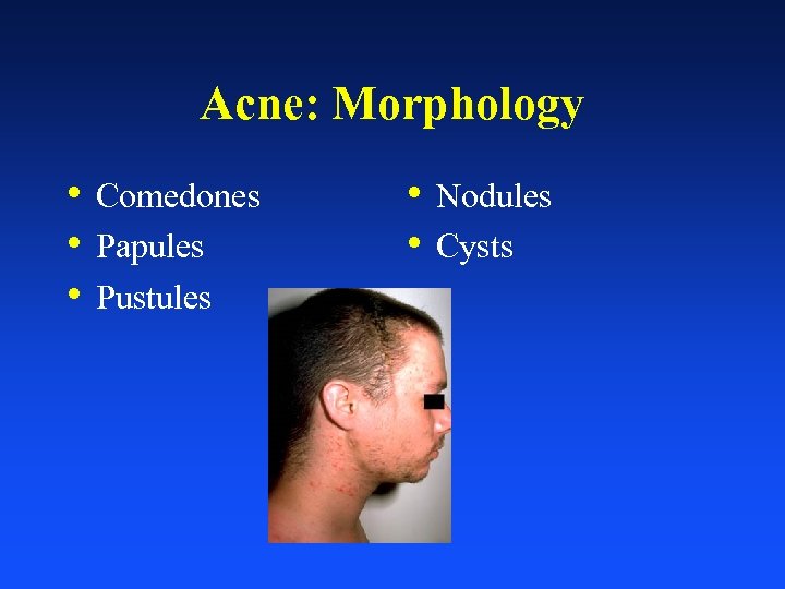 Acne: Morphology • Comedones • Papules • Pustules • Nodules • Cysts 
