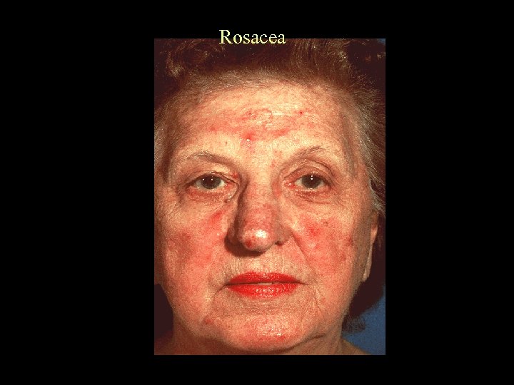 Rosacea 