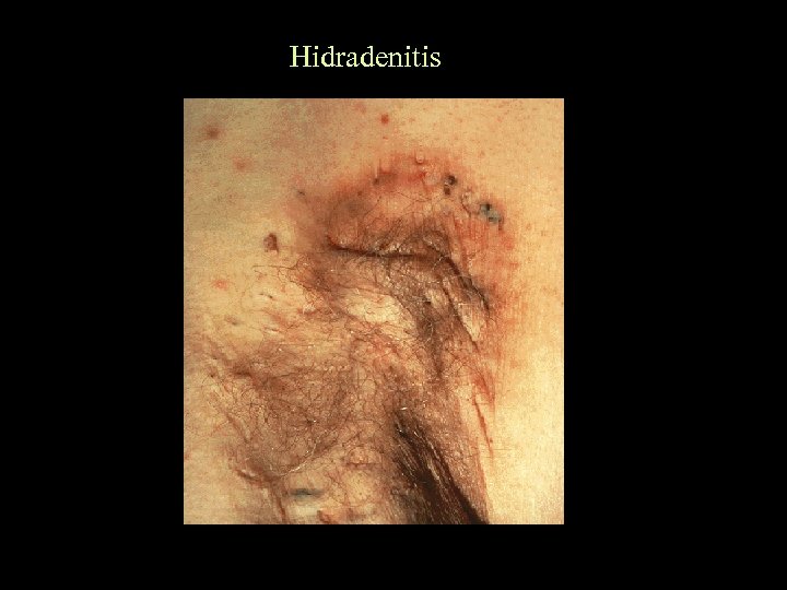 Hidradenitis 
